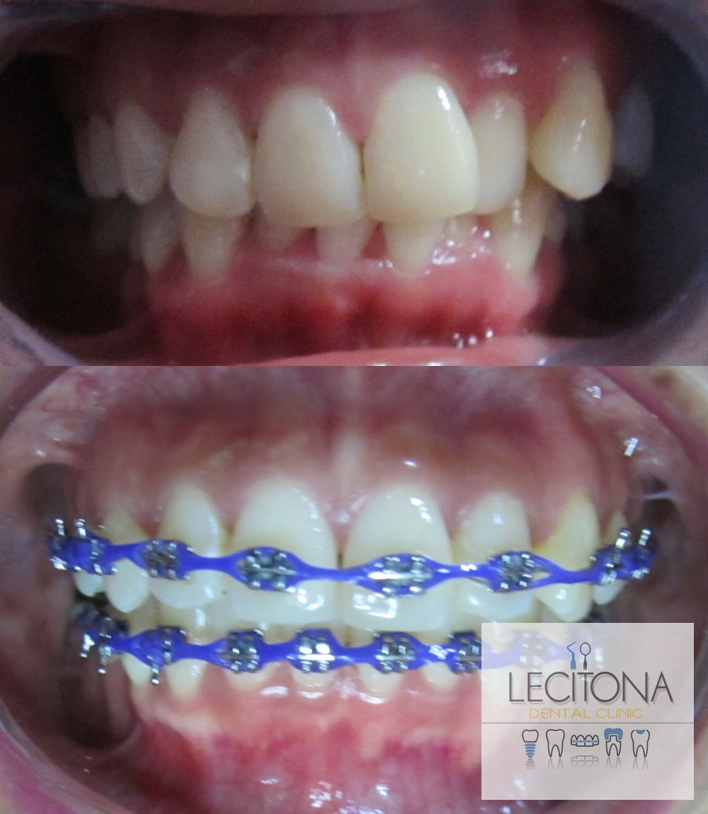 High quality braces in Pangasinan