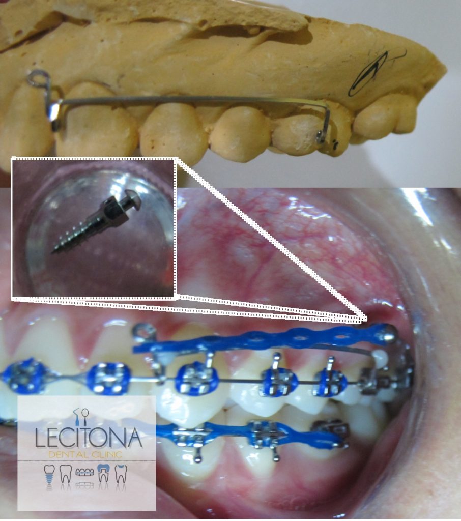 Temporary Anchorage Device TADS Pangasinan Orthodontist Philippines